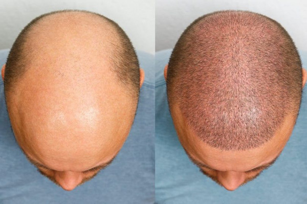 trapianto-capelli-3